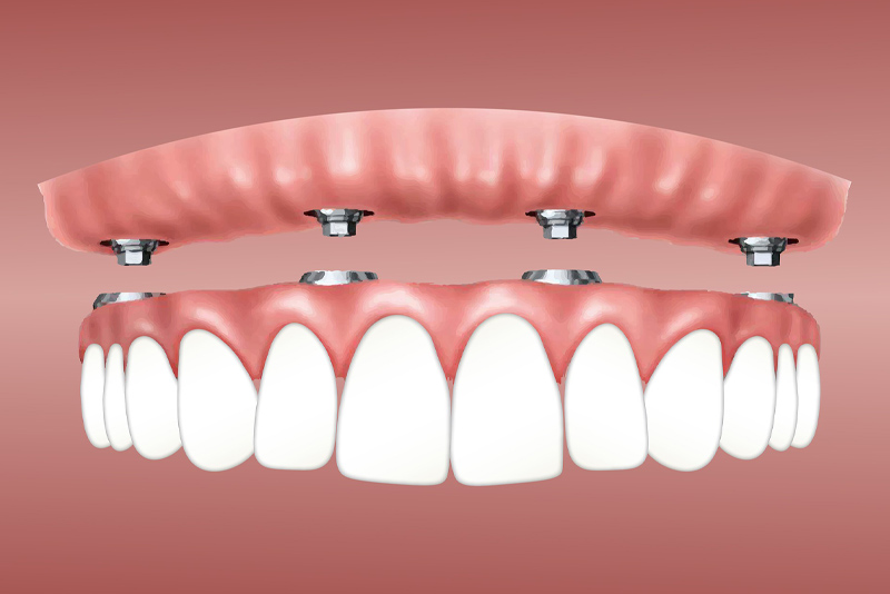 page-in7 dental implants roxburgh park