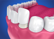 Porcelain Veneers, dentist roxburgh park