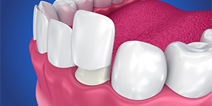 dental-implant Porcelain Veneers, dentist roxburgh park