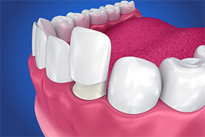 Porcelain Veneers, dentist roxburgh park