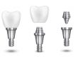 How Long Do All On 4 Dental Implants Last?