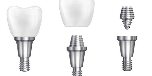 all-on-4-implant How Long Do All On 4 Dental Implants Last?