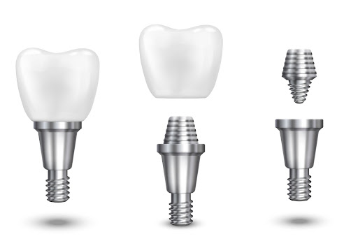 How Long Do All On 4 Dental Implants Last?