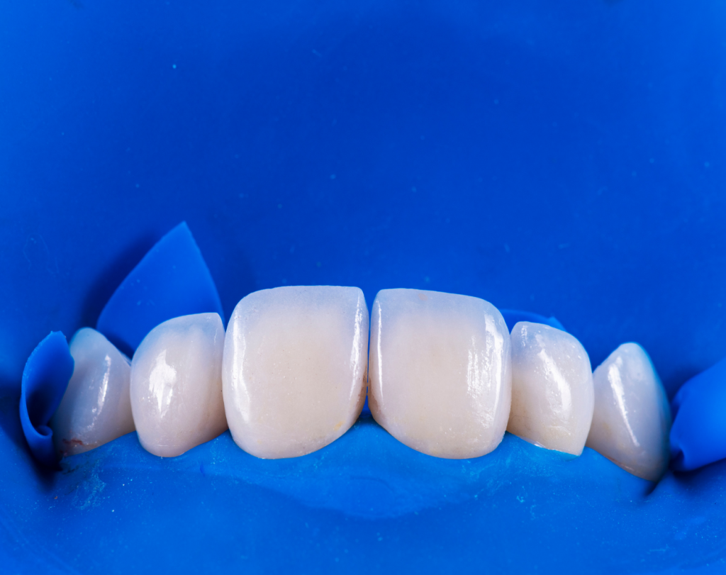 Dental-Veneers-Roxburgh-Park