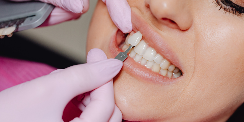 dental veneers roxburgh park dental-veneers-roxburgh-park.