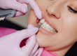 dental-veneers-roxburgh-park.