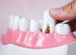 tooth extraction in Roxburgh Park