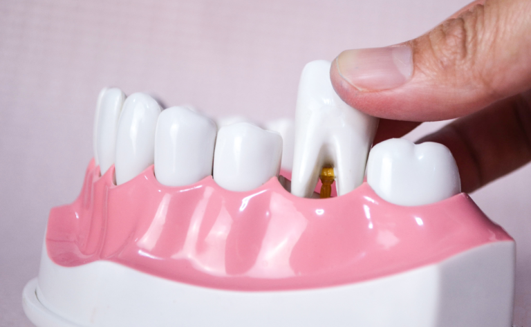 tooth extraction in Roxburgh Park