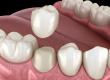 Dental Crown in Roxburgh Park
