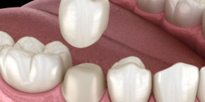Dental Crown in Roxburgh Park