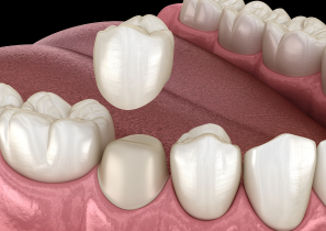 Dental Crown in Roxburgh Park